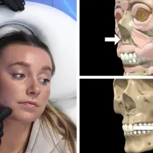 Masseter Case Study